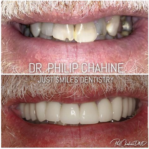 Teeth repair - results from Westerville Dentist Dr Phil Chahine