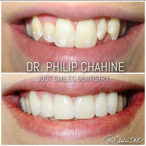 Porcelain Veneers Dentist in Hilliard OH