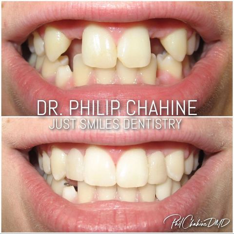Implant Dentistry - Columbus OH Dentists