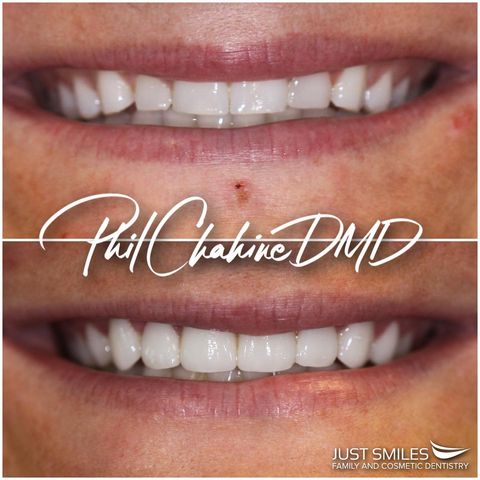 Porcelain Veneers - Hilliard Dentists