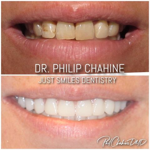 Smile Reconstruction - Hilliard Dentist