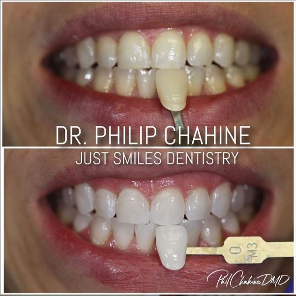 Teeth whitening - before and after - Just Smiles in Hilliard