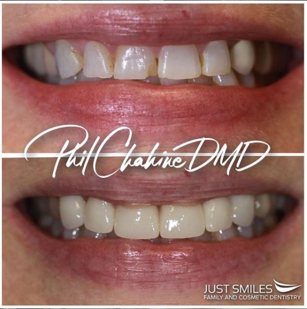 Results from Cosmetic Dentist Dr Phil Chahine in Hilliard OH