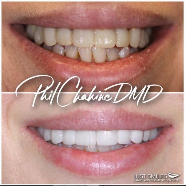 White teeth- results from Hilliard Dentist Dr. Phil Chahine