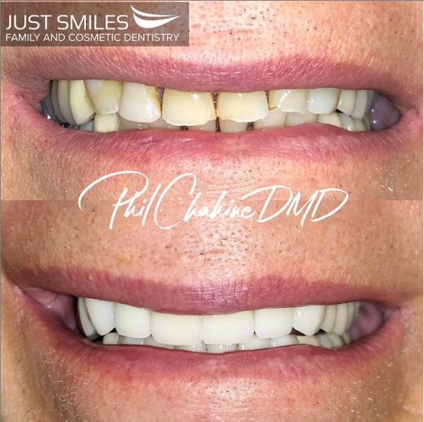 Restorative Dentistry - Before and After - Hilliard Dentist