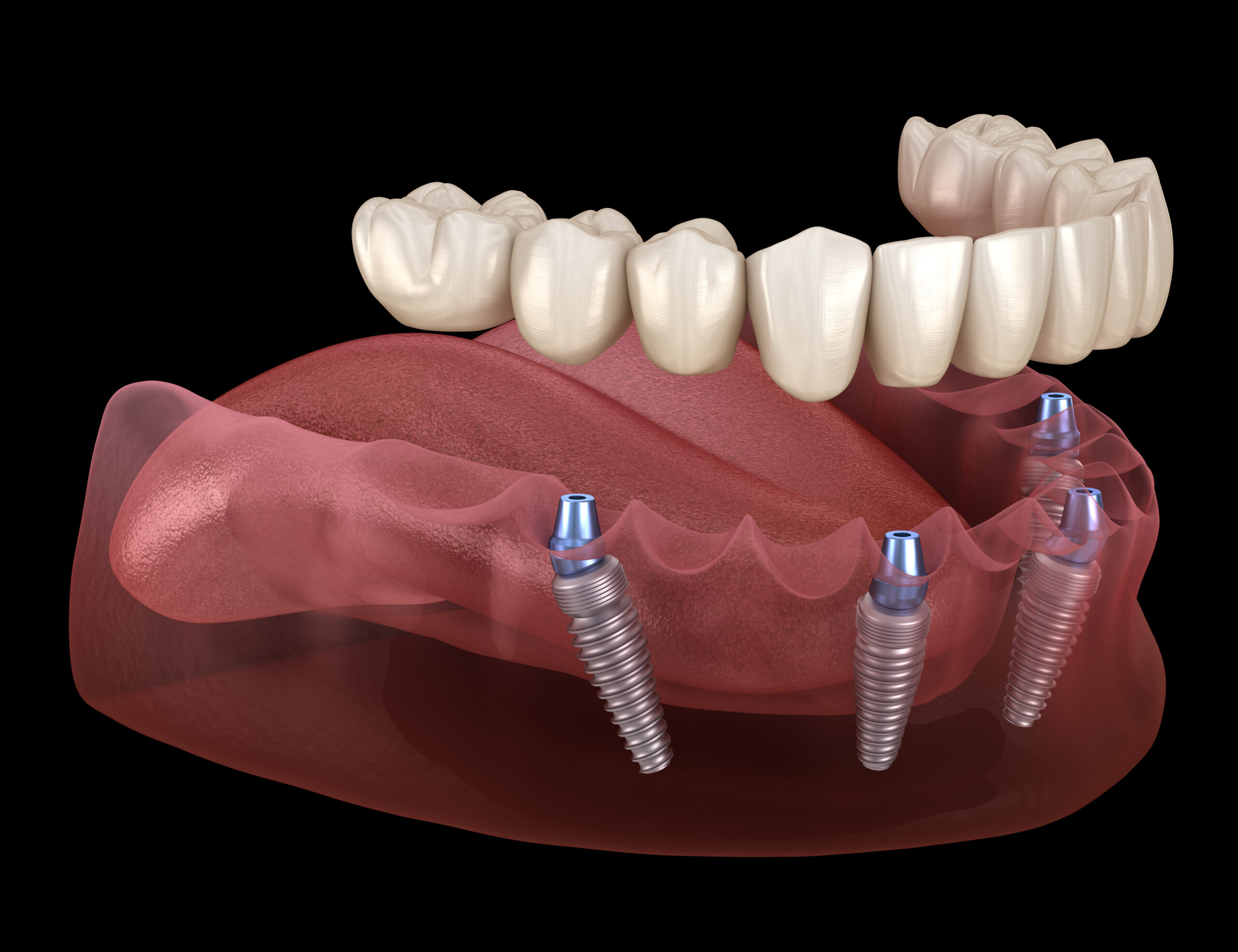 Preparing for a successful dental implant procedure.