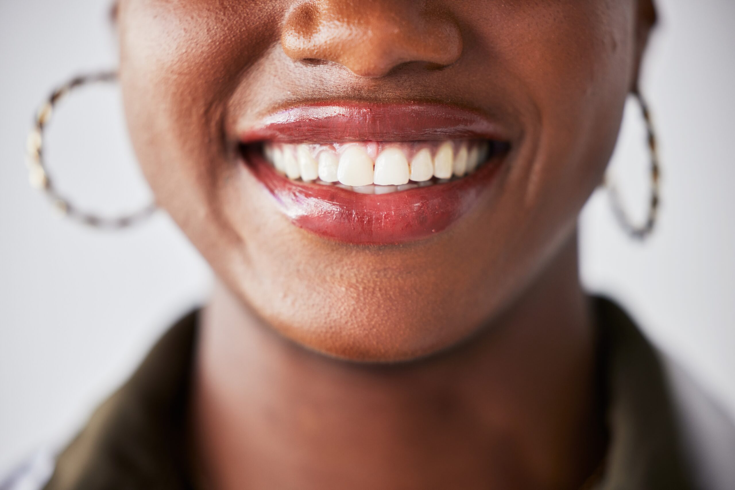 closeup of a young woman with professionally whitened teeth