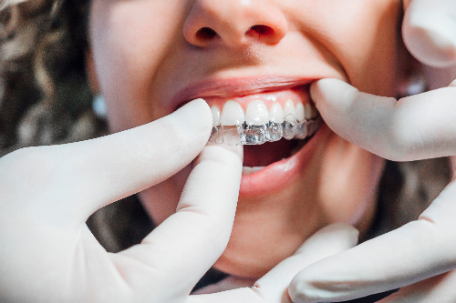 Doctor putting in a clear aligner in Westerville
