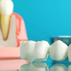 tooth bridge mounted by Columbus and Hilliard, OH dentist