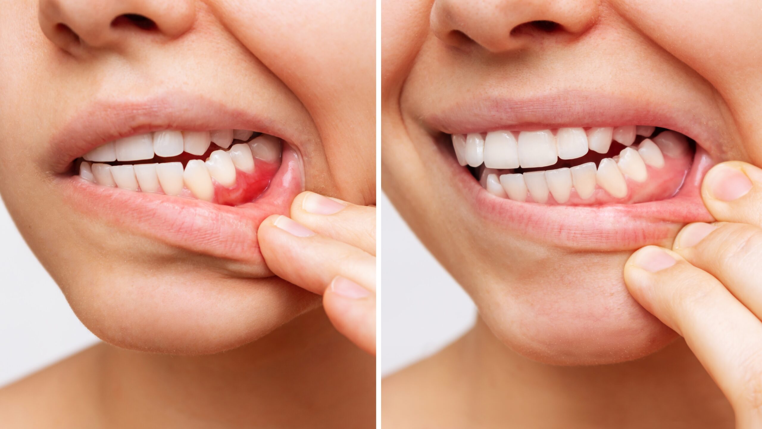 side by side closeup of gum disease progression