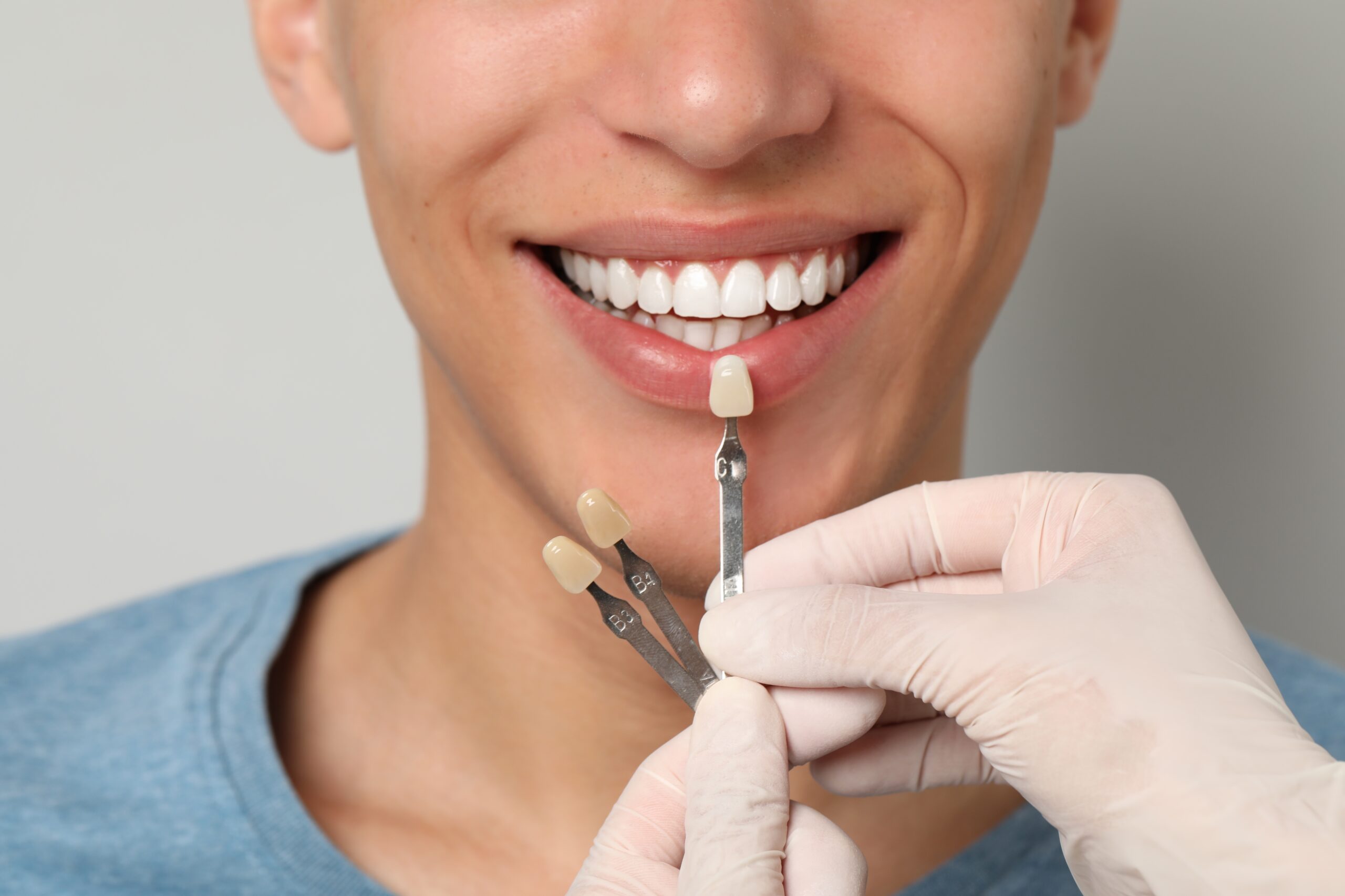 dentist checks the color of teeth, veneer placement